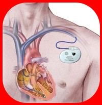 Mcgill pacemaker.jpg